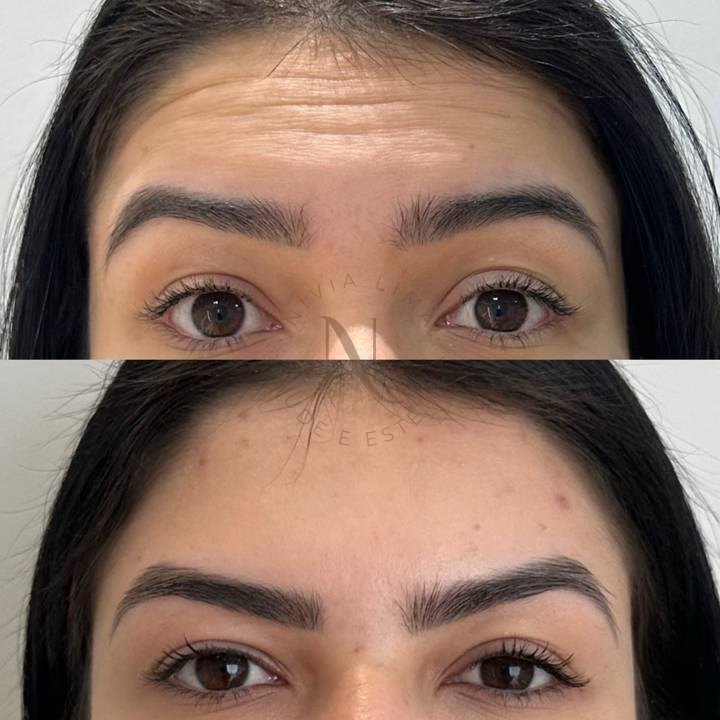 Botox na testa: antes em cima e depois embaixo