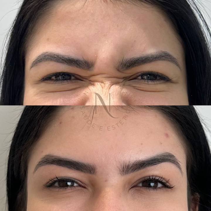 Botox entre as sobrancelhas: antes em cima e depois embaixo