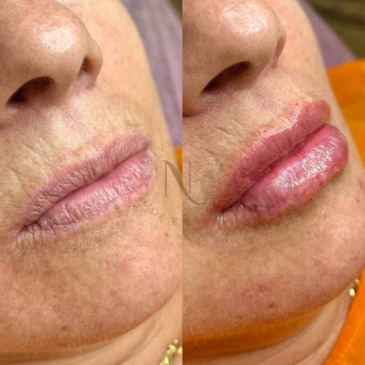 Preenchimento labial: antes à esquerda e depois à direita
